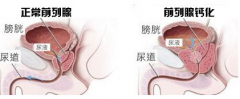 商丘治疗前列腺钙化哪家医院好？