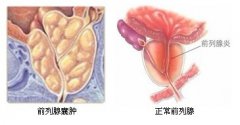 商丘治疗前列腺囊肿多少钱？